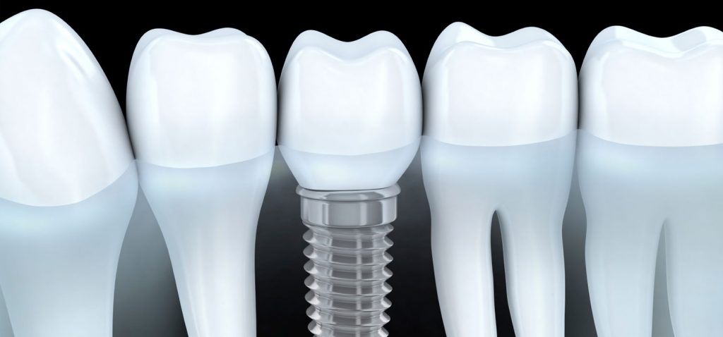 Dental Implants in Vancouver, BC - Sunrise Village Dental on Hastings St.