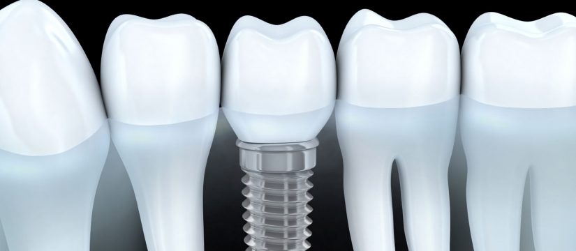 vancouver dental implants