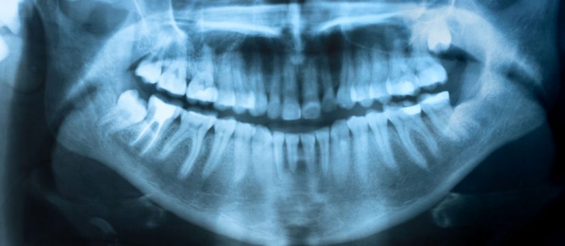 vancouver dental xray