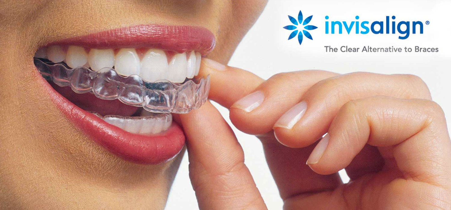 Invisalign Clear Braces - Smile Designers - Marshall MN Dentist