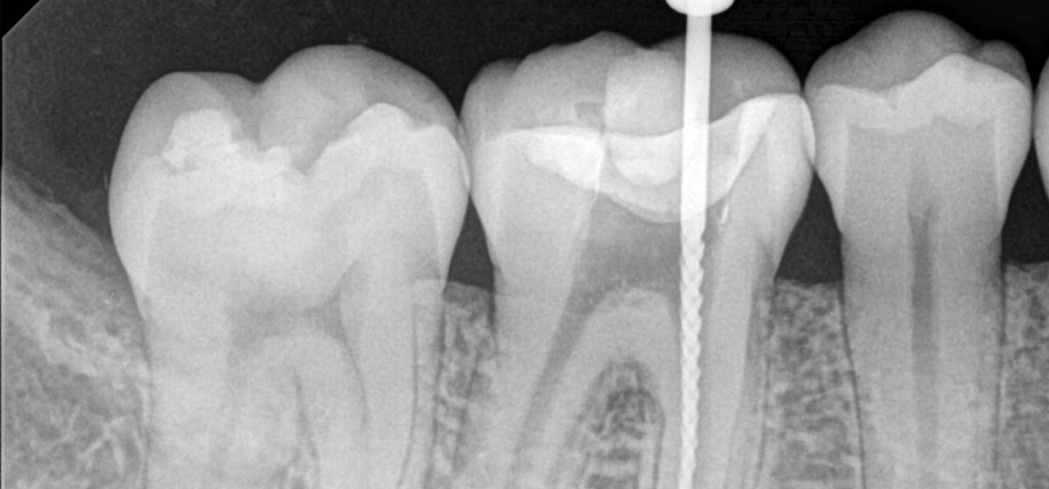 root canal xray