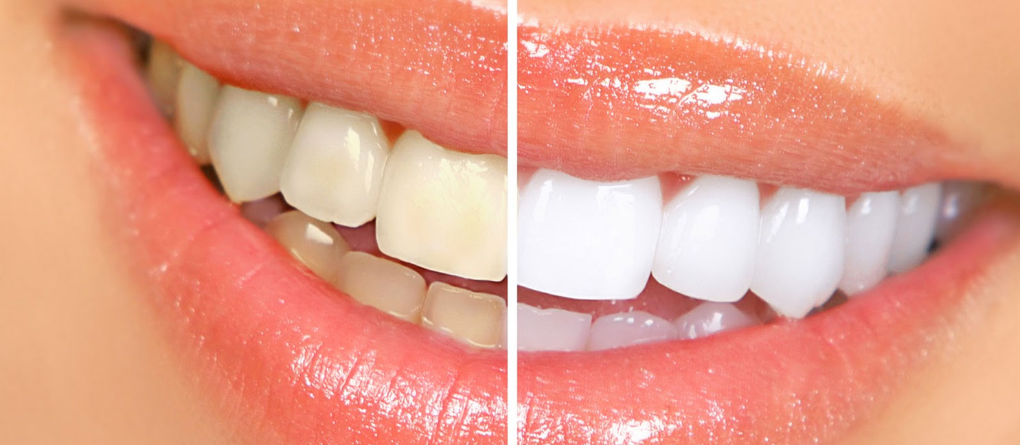 Best teeth whitening over the counter