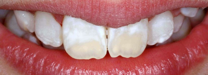 vancouver teeth discoloration