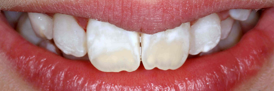 Tooth Discoloration What Should I Do Sunrise Village Dental On Hastings