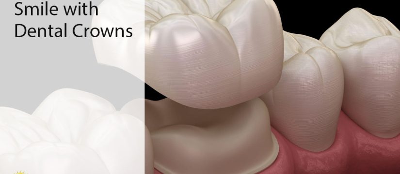 dental crowns