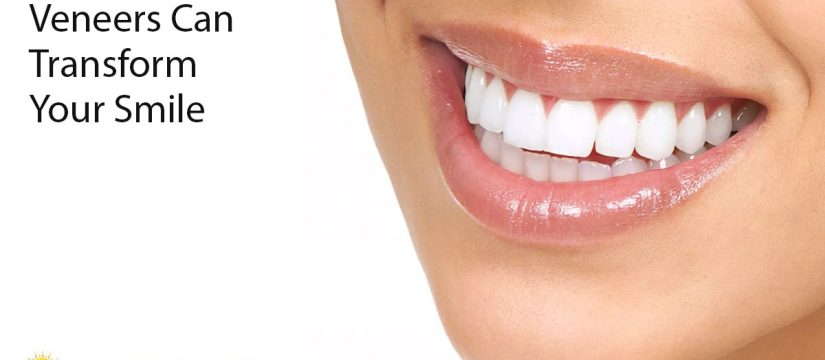 veneers