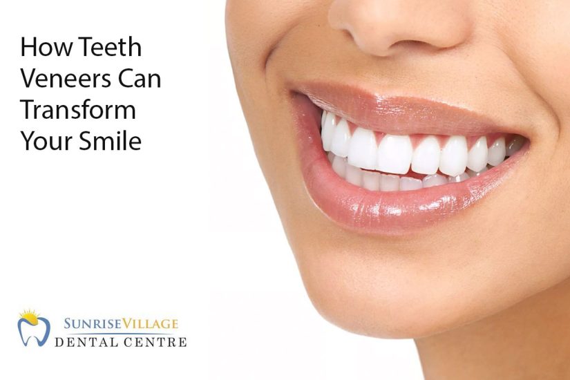 How Teeth Veneers Can Transform Your Smile Sunrise Village Dental Clinic
