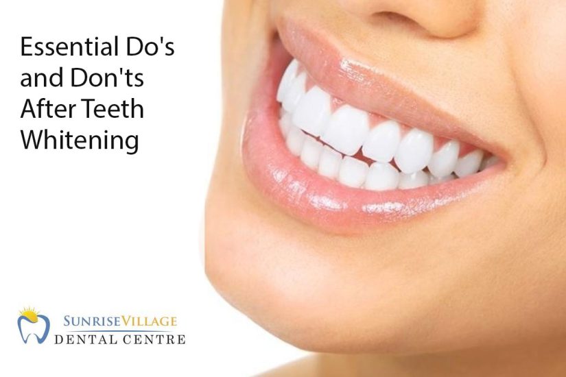 Essential Do's and Don'ts After Teeth Whitening Sunrise Village