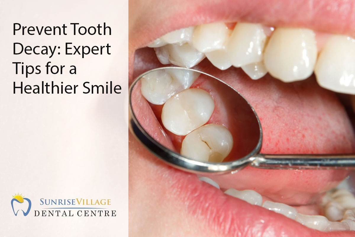 Prevent Tooth Decay: Expert Tips for a Healthier Smile - Sunrise Village  Dental Clinic