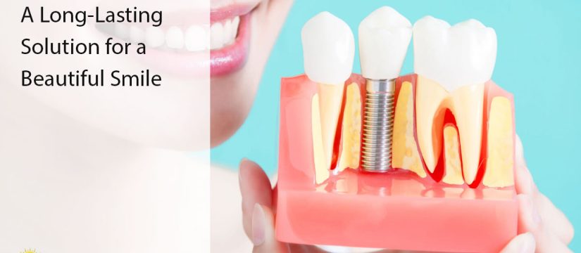 dental implants